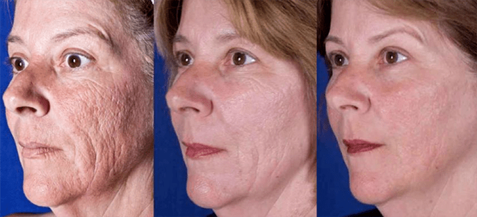 用激光使面部皮肤恢复活力后的结果